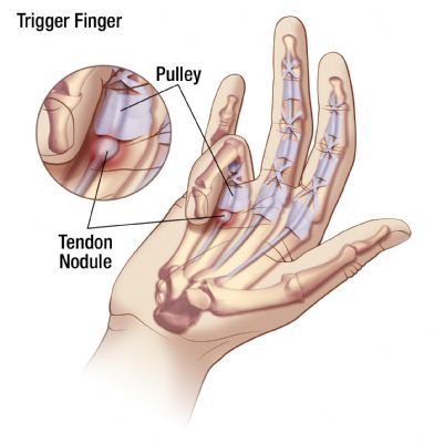 Trigger Finger Cumbria Medical Services